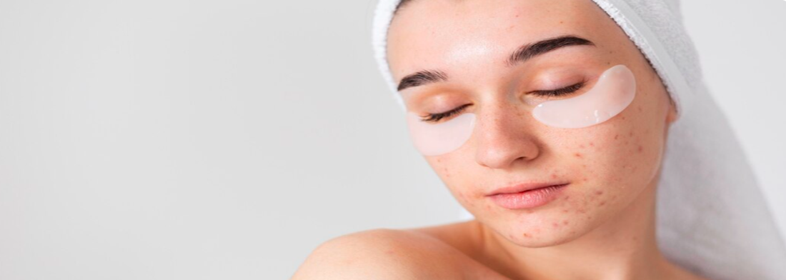 Close-up portrait of a young woman with visible acne and skin blemishes on her cheeks and jawline, eyes closed with white under-eye patches and a head towel against a clean neutral background, illustrating the need for professional acne scar treatment in Dubai