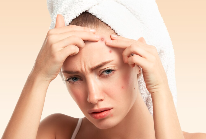 A young woman with a white towel on her head squeezing an inflamed pimple on her forehead, illustrating how active acne can lead to scarring
