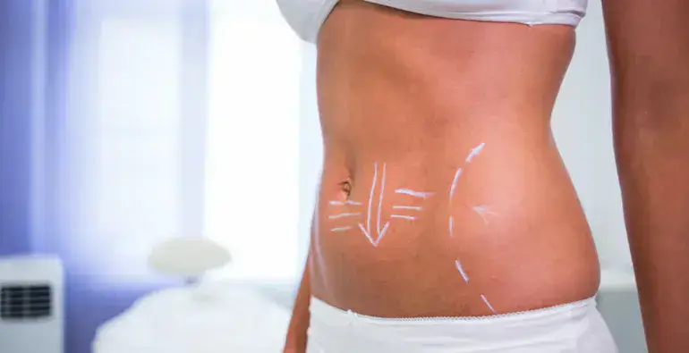 Woman's torso with clinical marking lines for body skin tightening treatment planning in a medical spa clinic - Dr. Elham Keikha Dubai