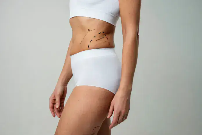 Side profile of a patient with clinical marking lines on the abdomen and hip during a body tightening consultation at Dr. Elham Keikha clinic in Dubai