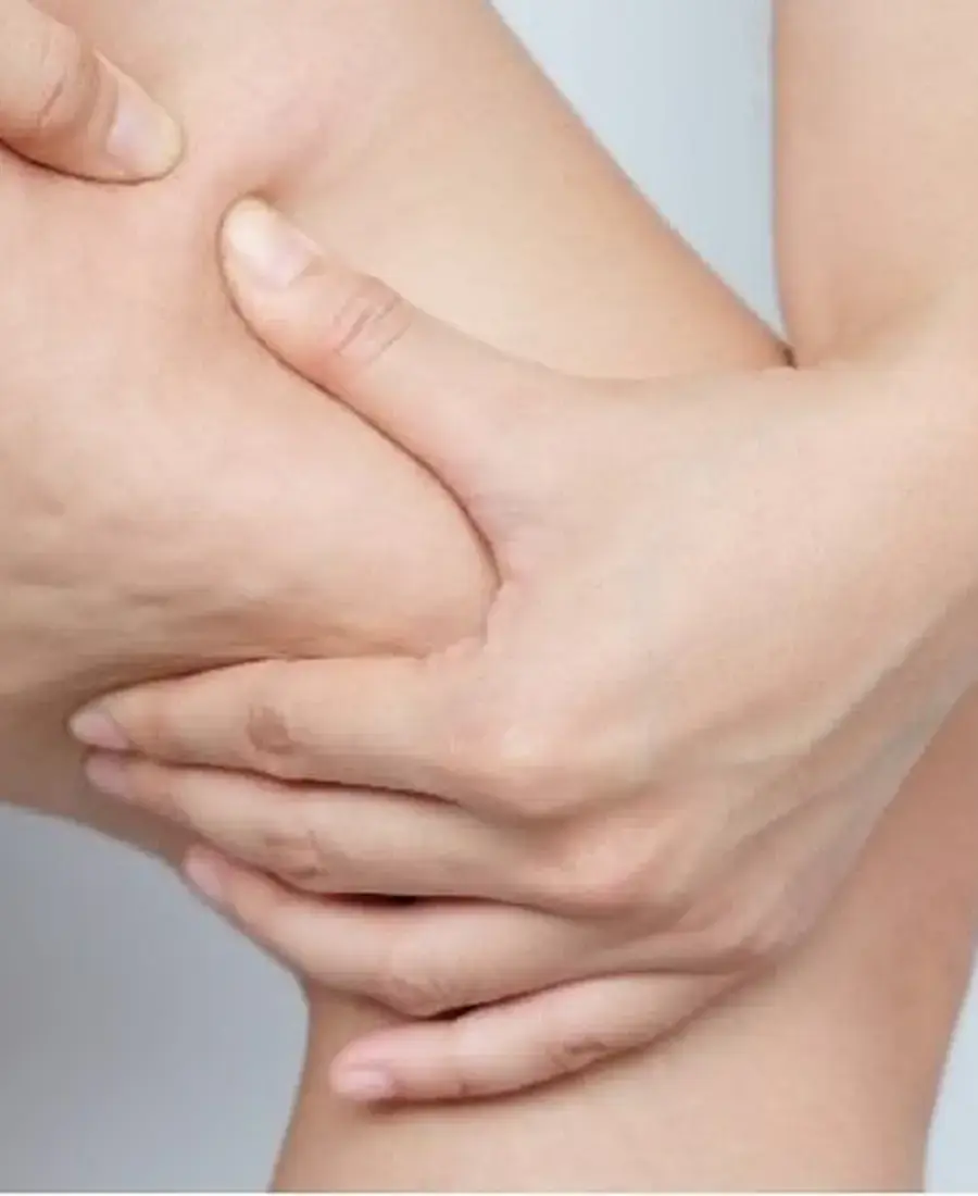Cellulite treatment for smoother thigh and buttock skin in Dubai at Dr. Elham Keikha clinic