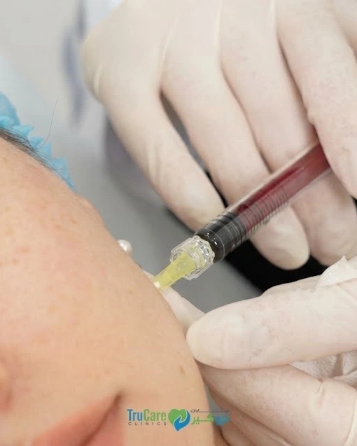 Close-up of a patient receiving a dermal filler injection in the cheek area at a clinic in Dubai