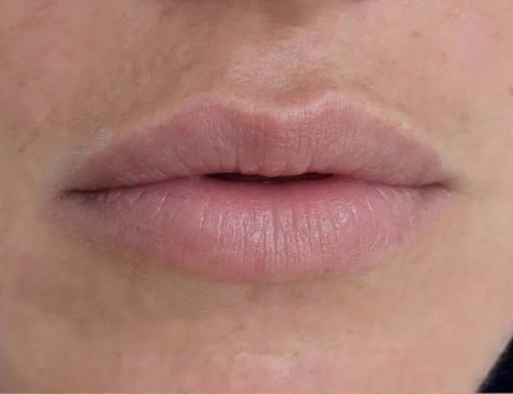 Before dermal filler lip enhancement — thinner natural lips