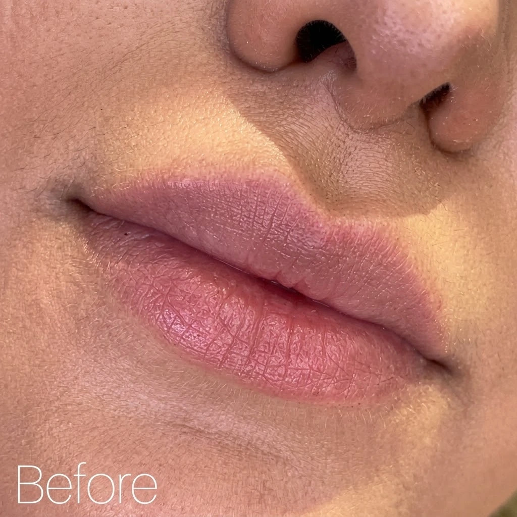 Before lip filler by Dr. Elham Keikha — natural lip shape