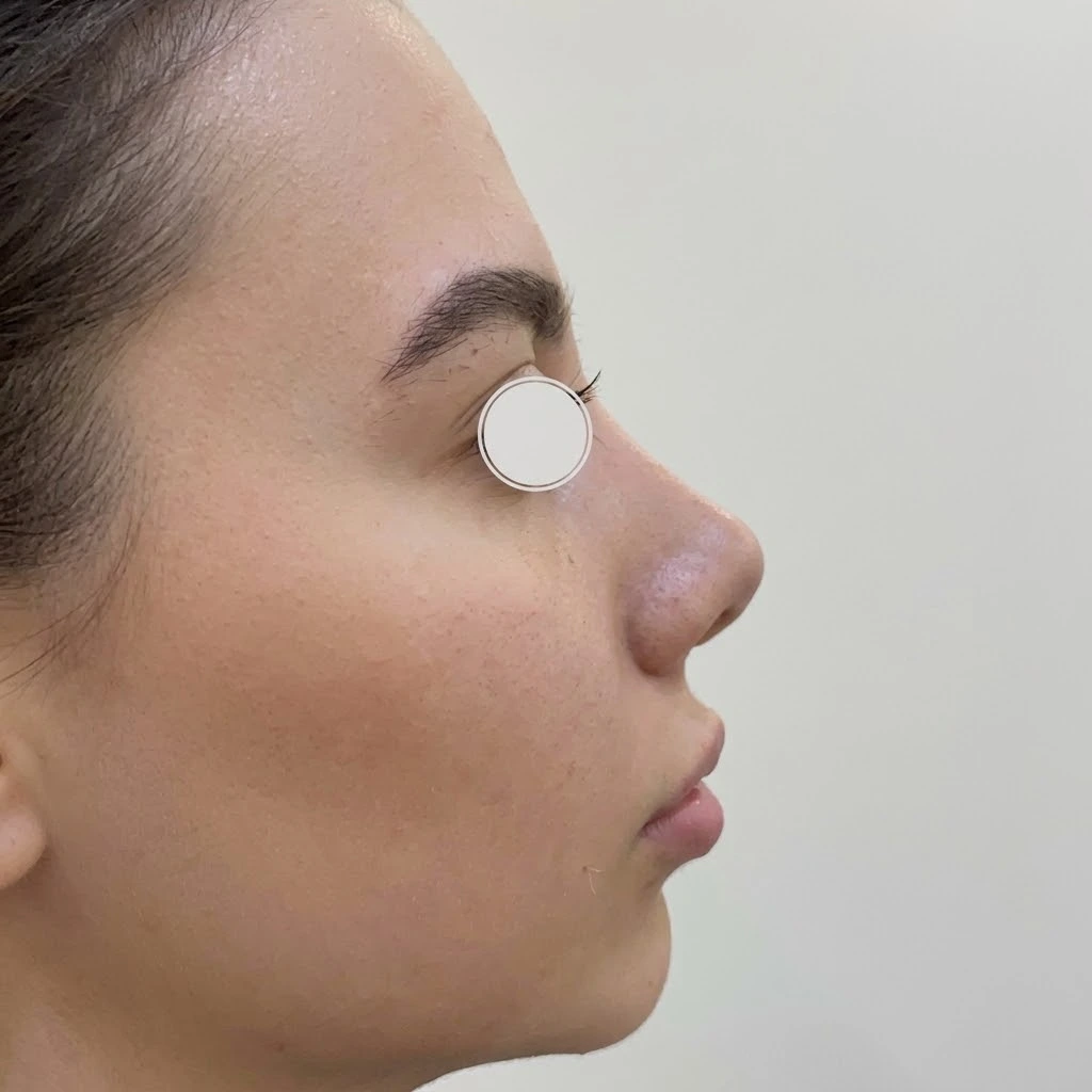 Before facial balancing with dermal fillers — profile view of chin and jawline