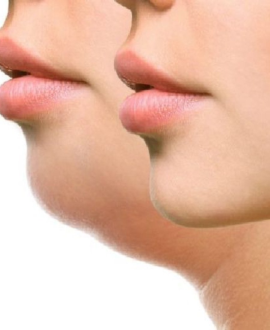 Double Chin Reduction Dr. Elham Keikha Dubai