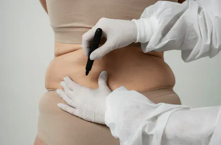 A medical professional marking a patient's lower back with a surgical marker during a fat reduction candidate assessment in Dubai