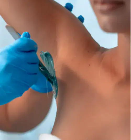 Clinical gel applied to a patient's underarm during hyperhidrosis consultation at Dr. Elham Keikha clinic in Dubai