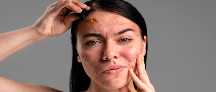 Professional laser treatment for acne scars being performed on a patient's forehead with a handheld medical laser device in a clinical setting