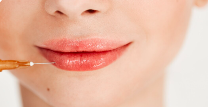 Close-up of a precise lip treatment demonstrating injectable lip flip technique in Dubai
