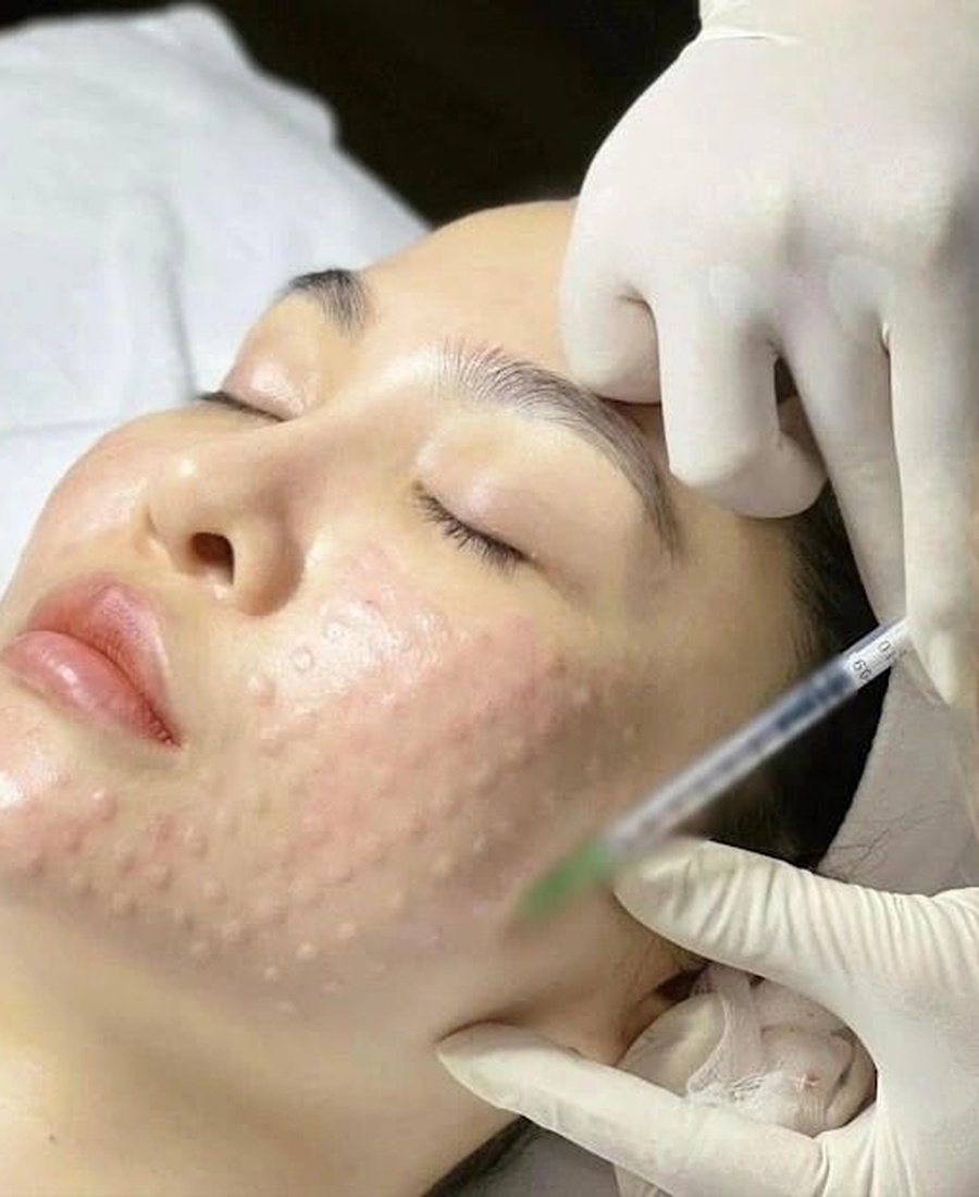 Mesotherapy Infusions Dr. Elham Keikha Dubai