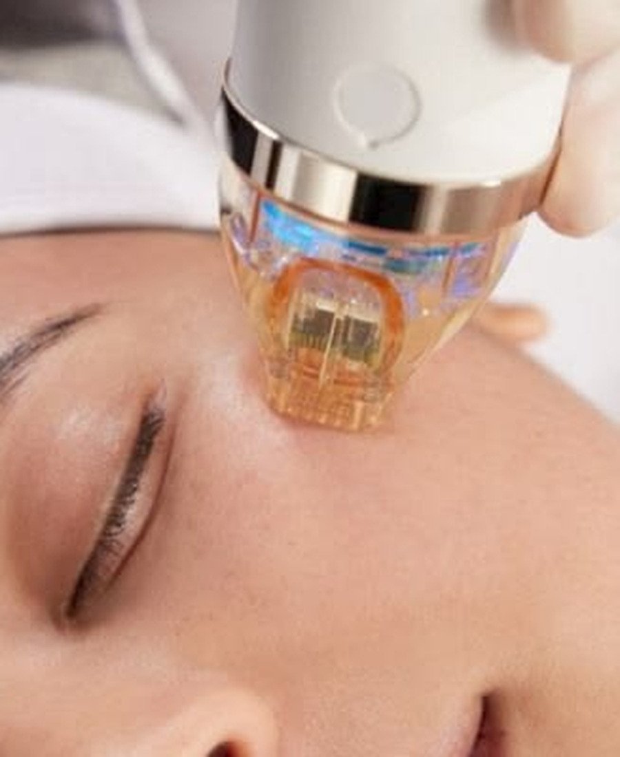 RF Microneedling treatment delivering radiofrequency energy for collagen remodeling and acne scar tightening - Dr. Elham Keikha Dubai