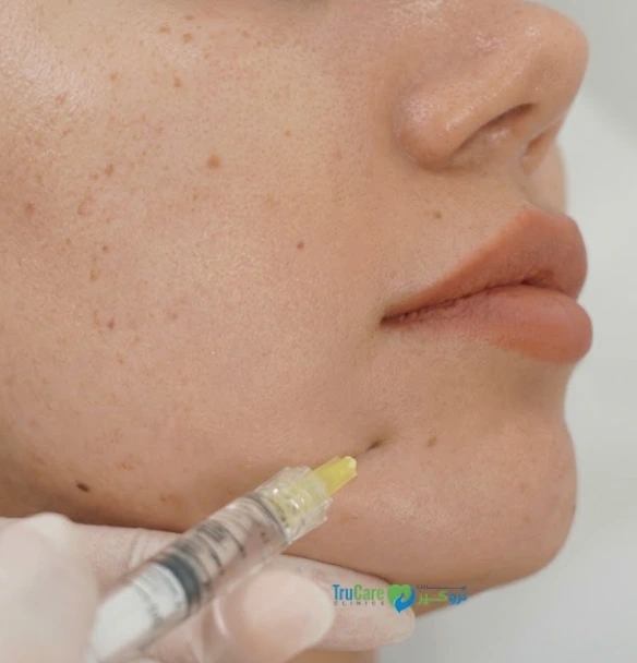 Close-up of a patient receiving a skin hydration injection treatment on the lower face and jawline at a clinic in Dubai