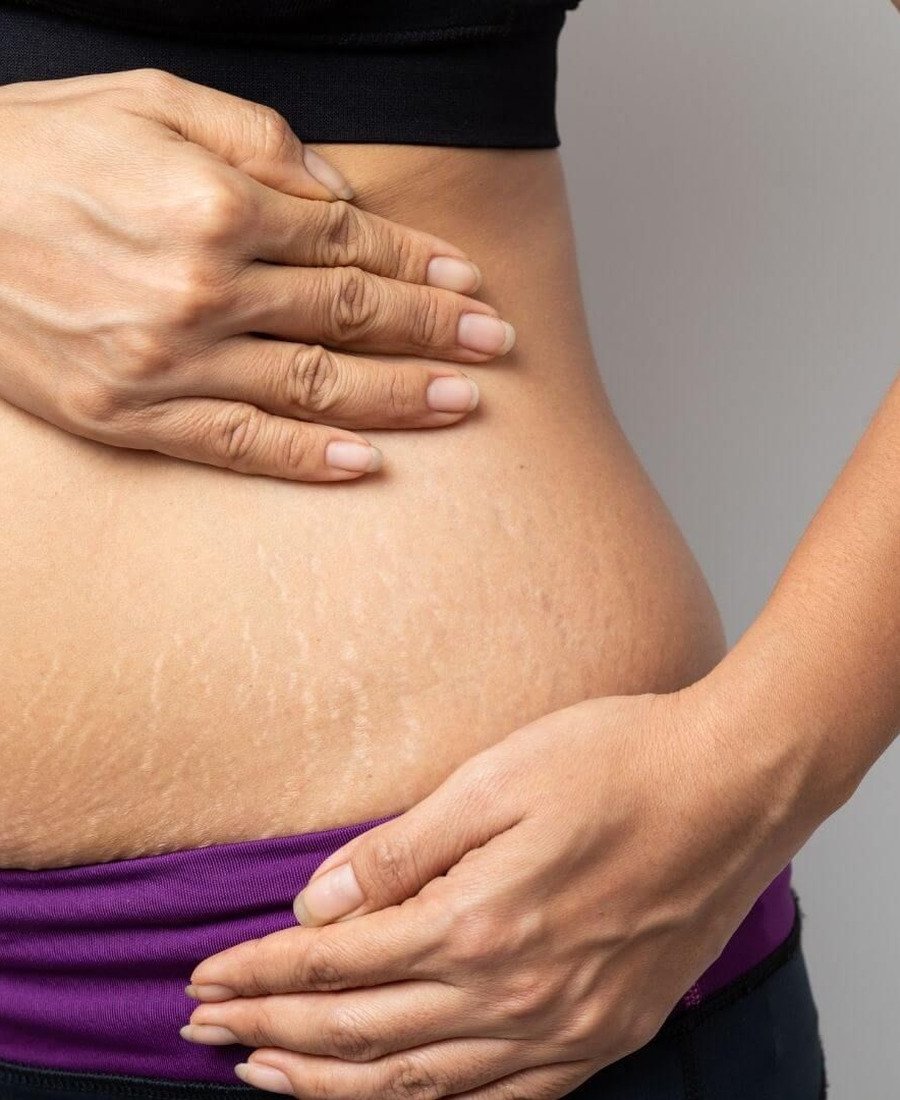 Stretch Mark Treatment Dr. Elham Keikha Dubai