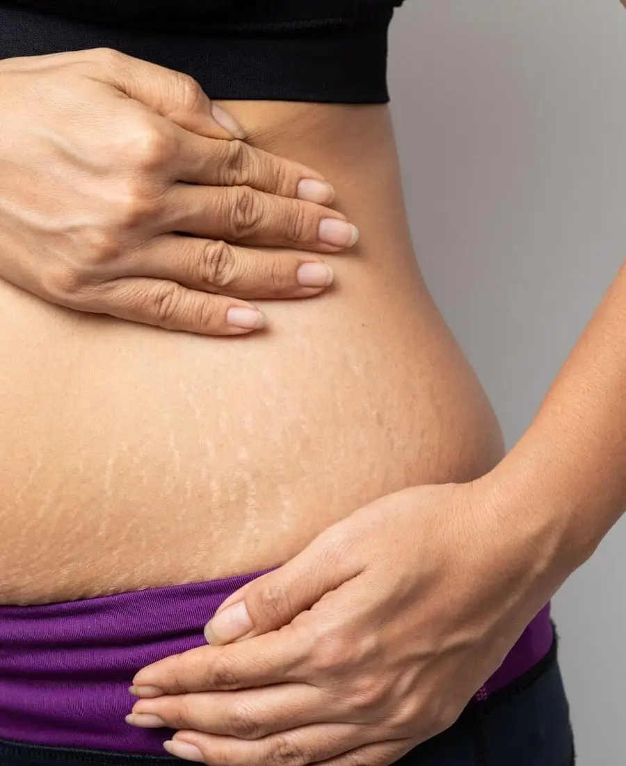Stretch mark treatment assessment and skin rejuvenation in Dubai