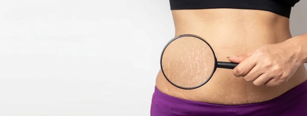 Close-up of abdominal stretch marks examined with a magnifying glass, representing stretch mark treatment in Dubai - Dr. Elham Keikha