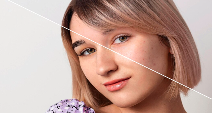RF Microneedling for acne scars in Dubai showing skin texture improvement and collagen remodeling