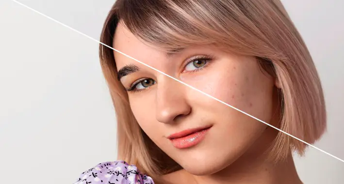 مقارنة قطرية قبل وبعد تُظهر وجه شابة بندبات حب الشباب وفرط التصبغ وتفاوت الملمس في جانب، وبشرة معالجة صافية وملساء في الجانب الآخر
