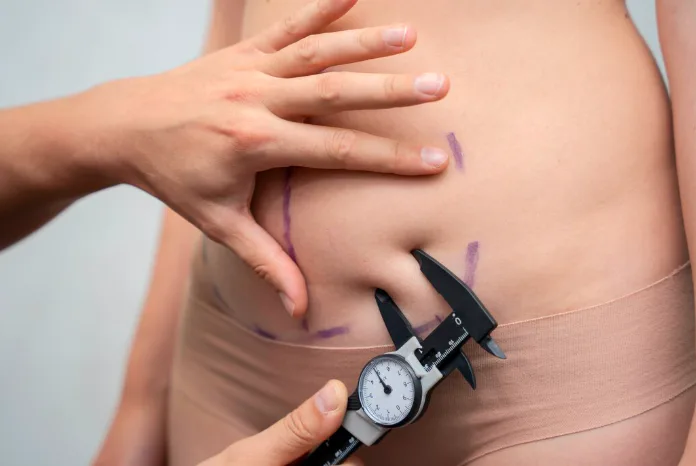 A medical professional using a skinfold caliper to measure localized fat on a patient's abdomen during a fat reduction assessment in Dubai