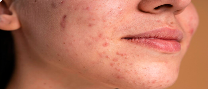 Close-up of a patient's cheek and jawline showing active acne, post-inflammatory hyperpigmentation, and uneven skin texture that may indicate the need for acne scar treatment