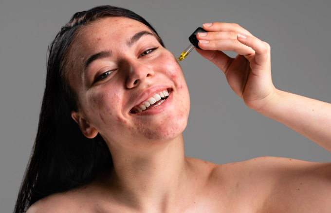 A woman with visible acne scars holding a serum dropper near her cheek, representing personalized acne scar treatment and doctor-guided skincare at Dr. Elham's clinic in Dubai