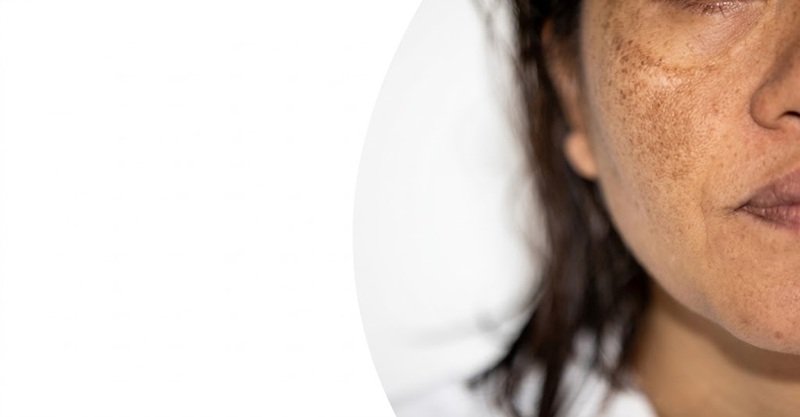 pigmentation starts returning after treatment, avoid immediately increasing the strength or frequency of your skincare products.