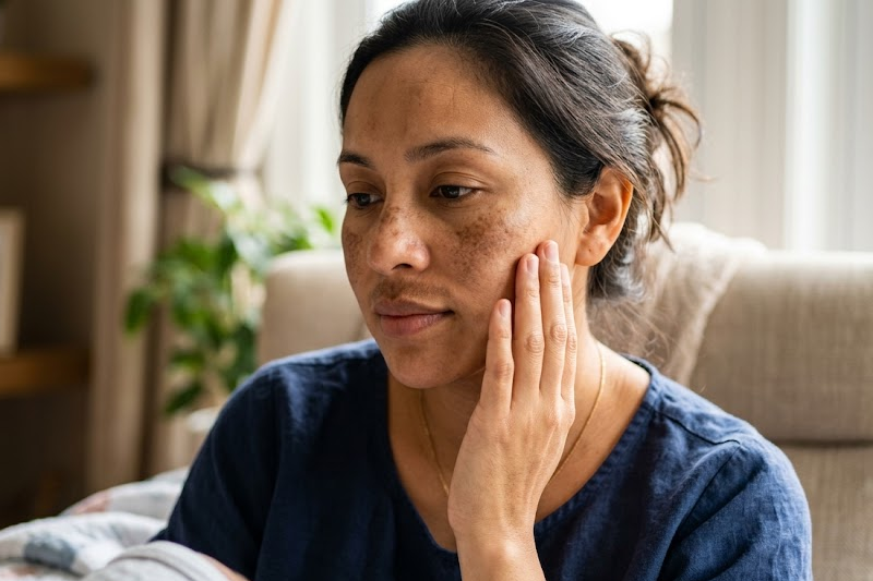 Melasma on a woman's face after pregnancy