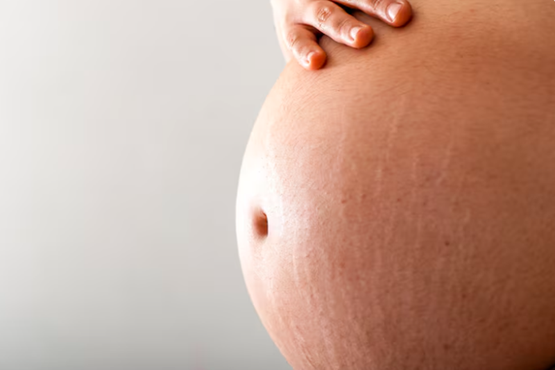 Can You Treat Pregnancy Hyperpigmentation During Pregnancy?