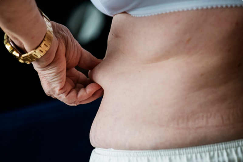 Loose Skin After Weight Loss: Your Non-Surgical Options