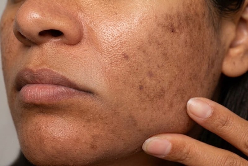 Rebound Pigmentation: Doctor’s Advice & Prevention