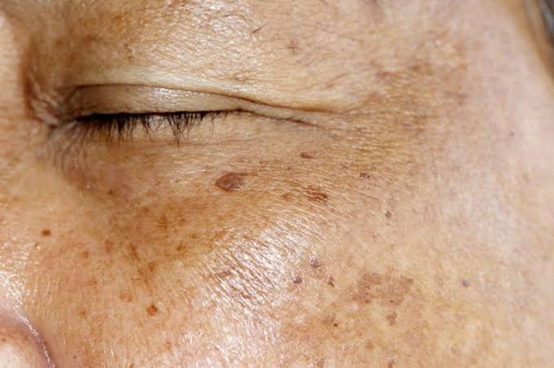 Rebound pigmentation is the recurrence or darkening of hyperpigmentation