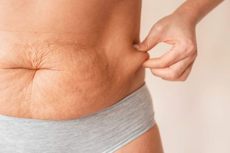 7 Best Stretch Mark Creams for Smoother, Healthier-Looking Skin