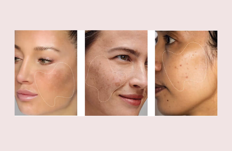 For people prone to melasma, a tinted sunscreen containing iron oxides may also provide protection