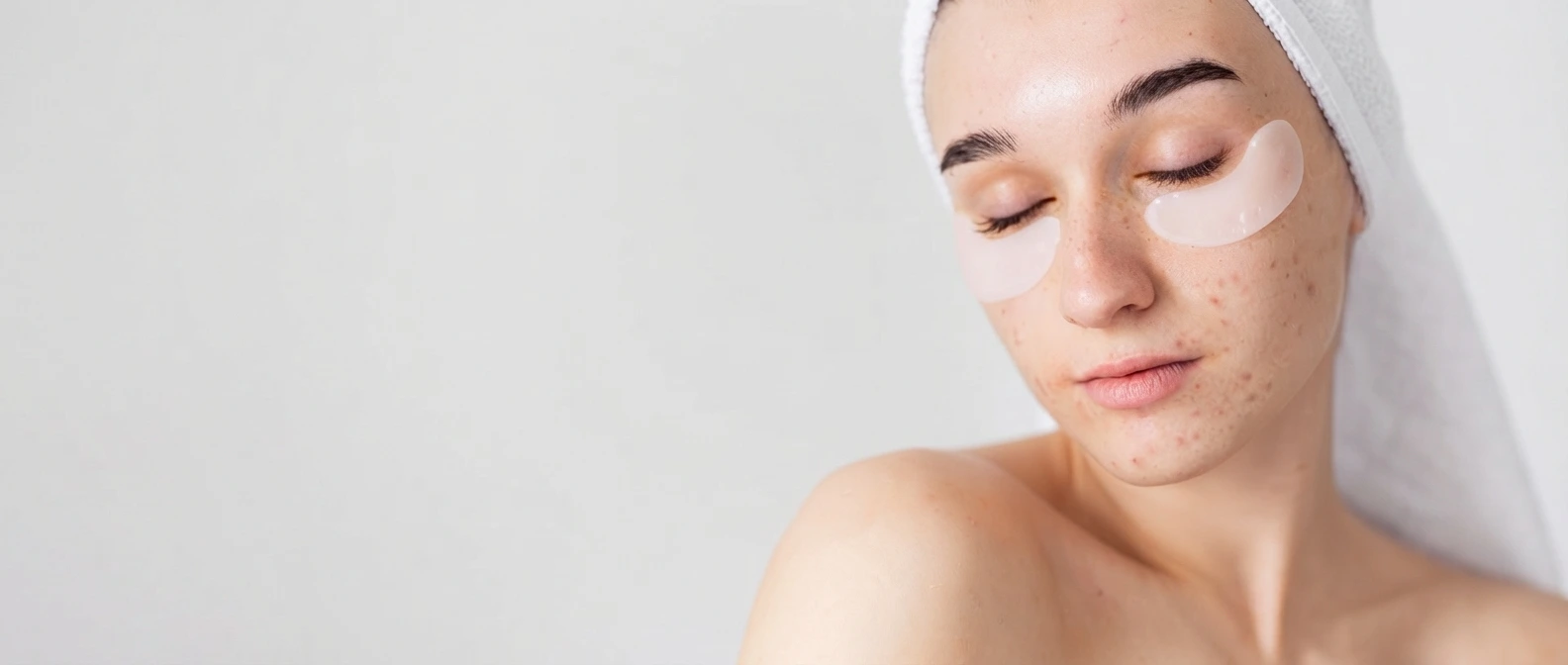 Close-up portrait of a young woman with visible acne and skin blemishes on her cheeks and jawline, eyes closed with white under-eye patches and a head towel against a clean neutral background, illustrating the need for professional acne scar treatment in Dubai