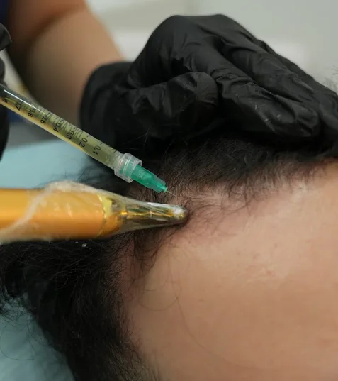 PRP hair treatment procedure at Dr. Elham Keikha clinic in Dubai
