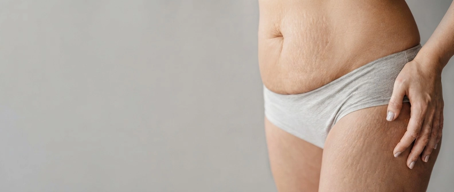 Close-up of abdominal and thigh stretch marks on soft neutral background, representing stretch mark treatment in Dubai - Dr. Elham Keikha